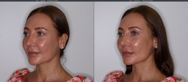 Voluma Dermal Filler - Cheeks