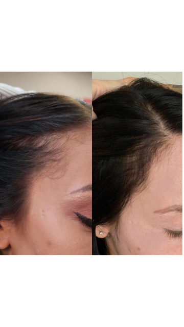 PRP Hair Restoration by Wellness Director Alex Tirado